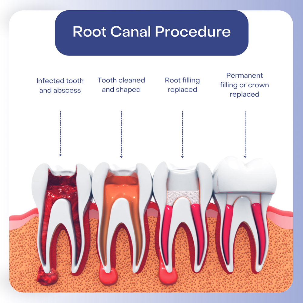 Root Canal Treatment