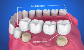 Crowns and Bridges