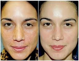 Advanced Chemical Peel